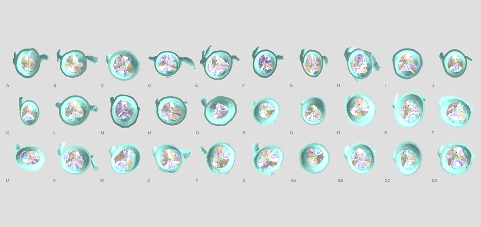 pre-procedural-fit-testing-transcatheter-aortic-valve-replacement-tavr-valves-using-parametric-modeling-3d-printing-5 pre-procedural-fit-testing-transcatheter-aortic-valve-replacement-tavr-valves-using-parametric-modeling-3d-printing-5